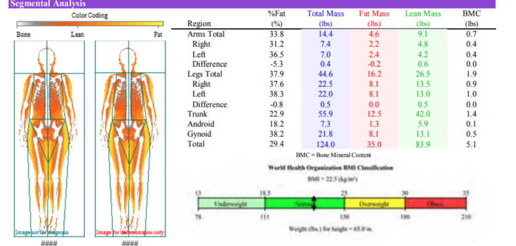 Segmented Body Composition DXA Scan results